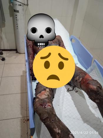 Dhuaarrrr!!! Sedang Racik Mercon, Meledak, Meninggal Dunia